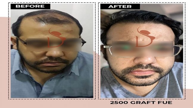 is Hair Transplant safe?