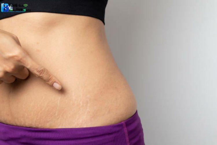 How to prevent stretch marks?